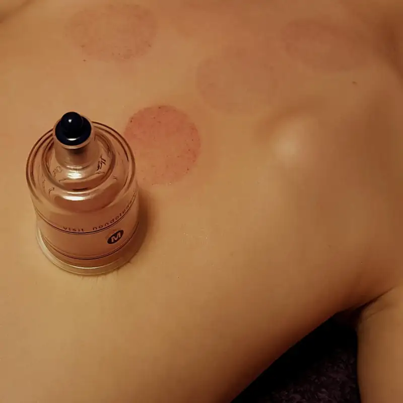 cupping-3310182_1280_Image by Pusteblume0815 from Pixabay